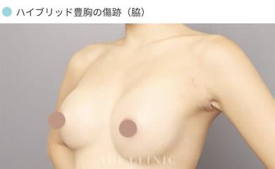 ハイブリッド豊胸の傷跡(脇)