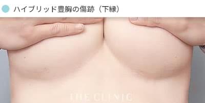 ハイブリッド豊胸の傷跡(下縁)