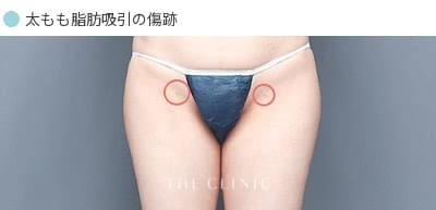 太もも脂肪吸引の傷跡