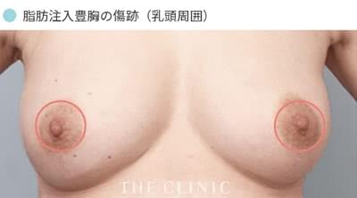 脂肪注入豊胸の傷跡(乳頭周囲)