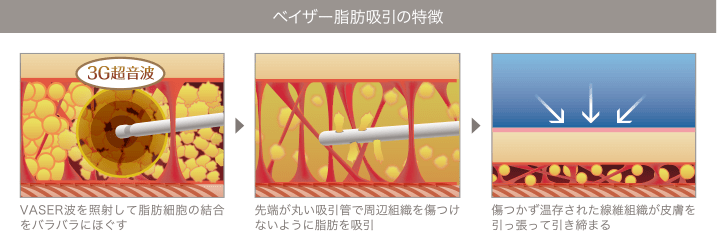 皮膚が引き締まる理由:温存された繊維組織が皮膚を引き締める