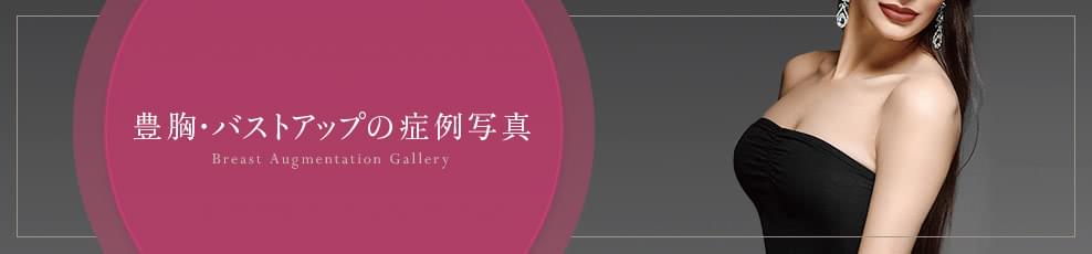 豊胸・バストアップの症例写真