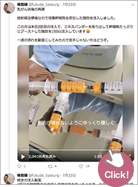 脂肪注入による乳房再建に関するツイート