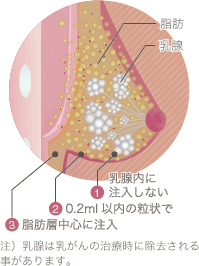 脂肪注入におけるコールマンテクニックのポイント