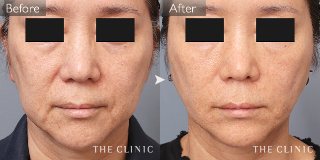 '症例写真 / マイクロCRF注入(顔の脂肪注入) 術前・術後