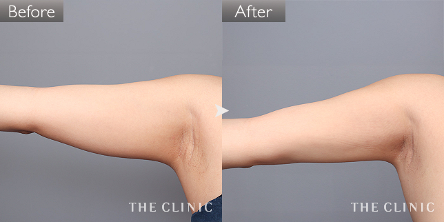 '症例写真 / ベイザー脂肪吸引 術前・術後