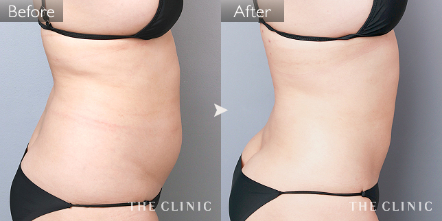 '症例写真 / ベイザー脂肪吸引 術前・術後