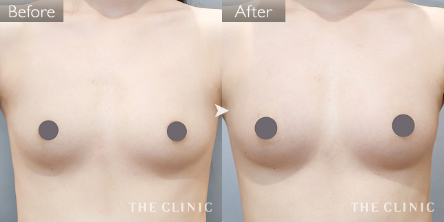 '症例写真 / コンデンスリッチ豊胸 術前・術後