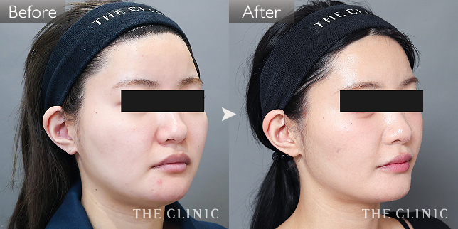 '症例写真 / ベイザー脂肪吸引 術前・術後