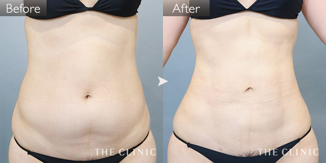 '症例写真 / ベイザー脂肪吸引 術前・術後