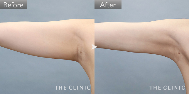 '症例写真 / ベイザー脂肪吸引 術前・術後