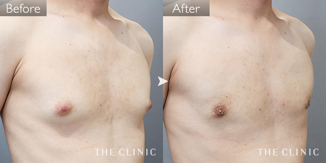 '症例写真 / 女性化乳房治療(男性の胸の膨らみ改善) 術前・術後