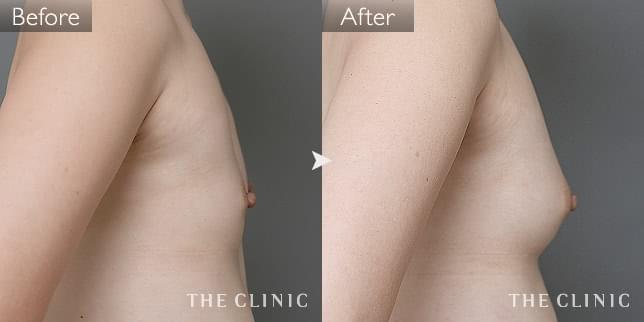 '症例写真 / コンデンスリッチ豊胸 術前・術後