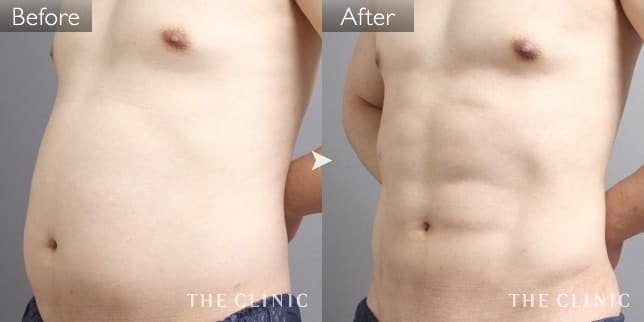 '症例写真 / ベイザー4D(男性のシックスパック脂肪吸引) 術前・術後