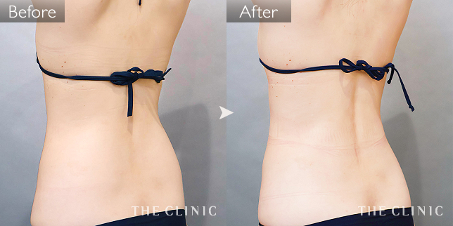 '症例写真 / ベイザー脂肪吸引 術前・術後