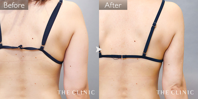 '症例写真 / ベイザー脂肪吸引 術前・術後