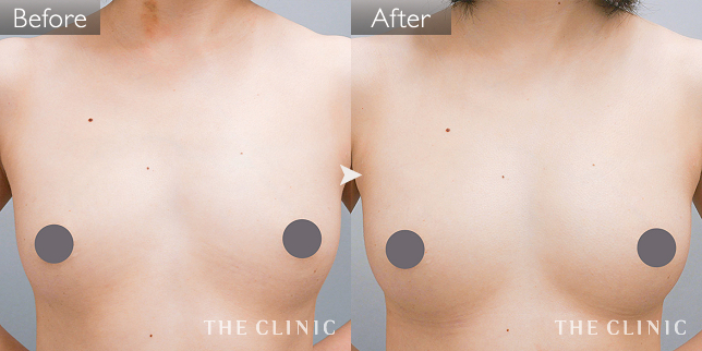 症例写真 / コンデンスリッチ豊胸 術前・術後