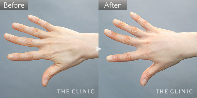 '症例写真 / 手の甲への脂肪注入(ハンドリバイブ) 術前・術後