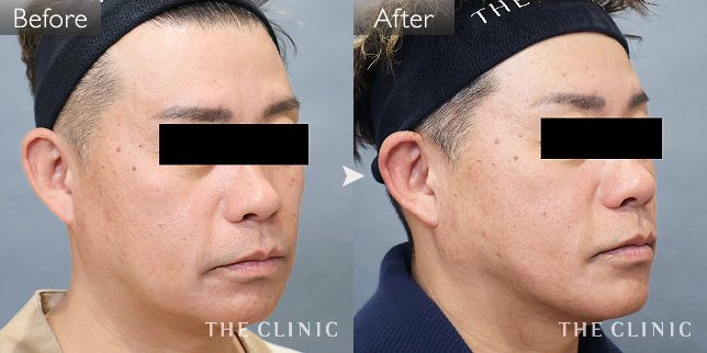 '症例写真 / VOVリフト(ボブリフト・プレミアム) 術前・術後