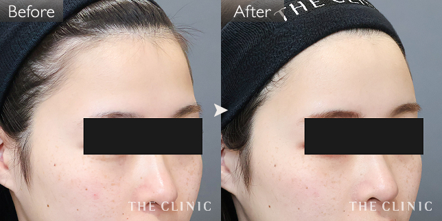 '症例写真 / コンデンスリッチフェイス(顔の脂肪注入) 術前・術後