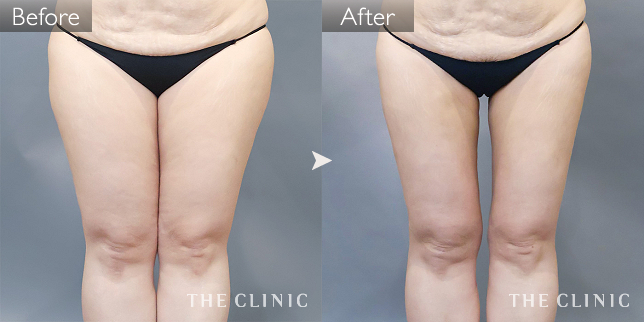 '症例写真 / ベイザー脂肪吸引 術前・術後