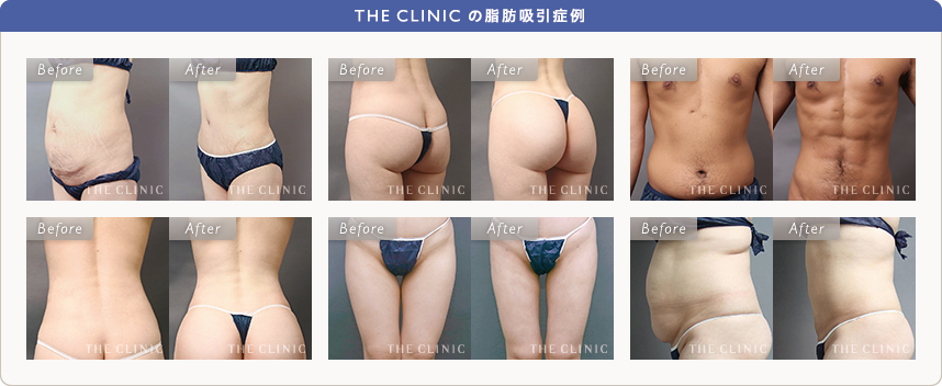 THE CLINIC の脂肪吸引症例
