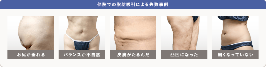 他院での脂肪吸引による失敗事例: お尻が垂れる／バランスが不自然／皮膚がたるんだ／凸凹になった／細くなっていない