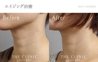 首のシワのマイクロCRF注入(顔の脂肪注入)症例写真（女性／36歳）-術前/術後