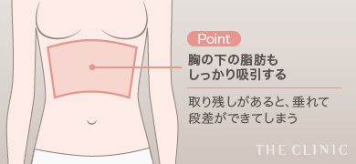 Point 胸の下の脂肪もしっかり吸引する 取り残しがあると、垂れて段差ができてしまう