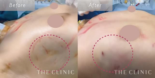 よくわかる! 脂肪注入の乳房再建【効果・費用・注意点】｜THE CLINIC