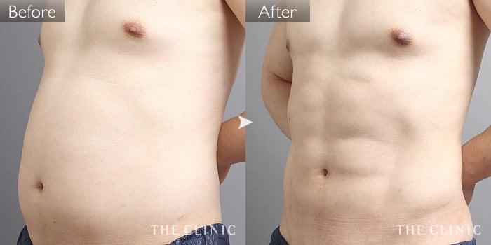 脂肪吸引 Six Pack 6つに割れた腹筋 の症例写真 45歳 男性 ザクリニック名古屋院 脂肪吸引 Six Pack 6つに割れた腹筋 の症例写真 45歳 男性 ザクリニック名古屋院