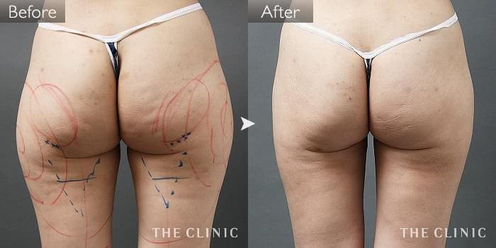 脂肪吸引 お尻 の症例写真 35歳 女性 ザクリニック名古屋院