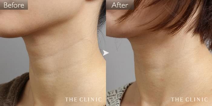 脂肪注入 首のシワ改善 の症例写真 36歳 女性 ザクリニック名古屋院 脂肪注入 首のシワ改善 の症例写真 36歳 女性 ザクリニック名古屋院