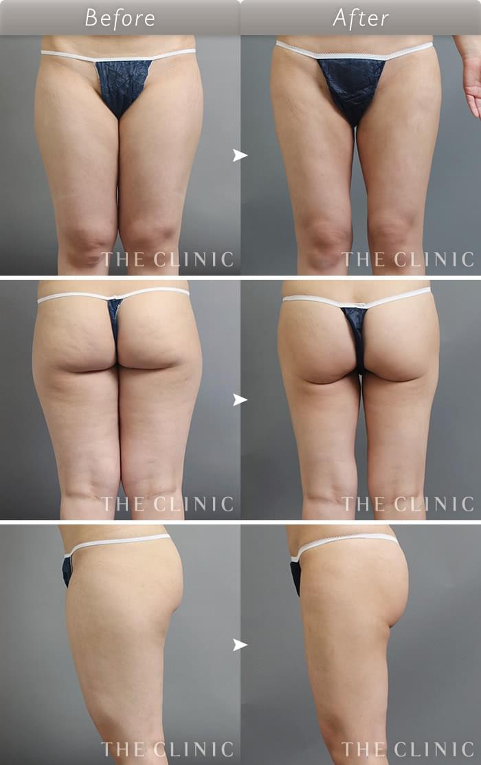脂肪吸引 太もも の症例写真 24歳 女性 ザクリニック名古屋院 脂肪吸引 太もも の症例写真 24歳 女性 ザクリニック名古屋院