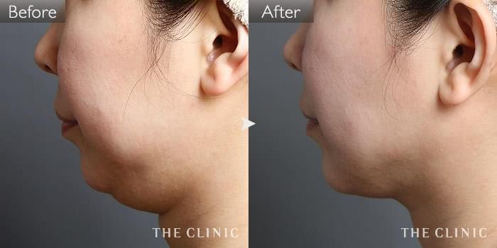 脂肪吸引 顔 ホホ アゴ の症例写真 39歳 女性 ザクリニック名古屋院 脂肪吸引 顔 ホホ アゴ の症例写真 39歳 女性 ザクリニック名古屋院