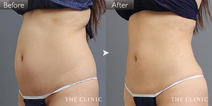 脂肪吸引 腹部 の症例写真 24歳 女性 ザクリニック名古屋院 脂肪吸引 腹部 の症例写真 24歳 女性 ザクリニック名古屋院