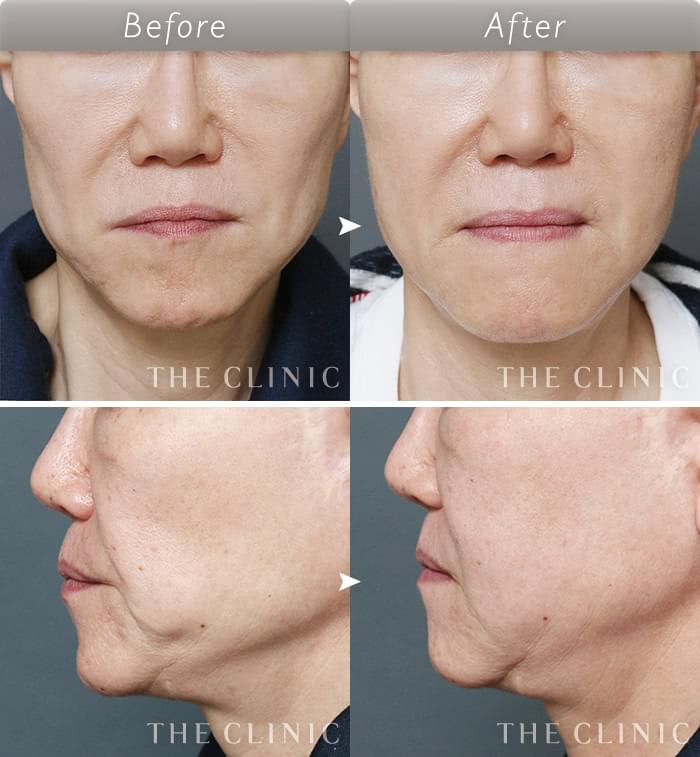 顔の脂肪注入 頬コケの改善 の症例写真 56歳 女性 ザクリニック名古屋院 顔の脂肪注入 頬コケの改善 の症例写真 56歳 女性 ザクリニック名古屋院