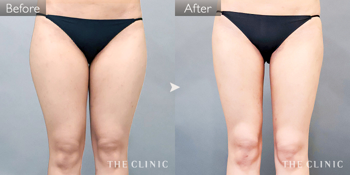 脂肪吸引「腰・ウエスト」の症例写真（33歳/女性）｜ザクリニック名古屋院