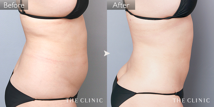 脂肪吸引「腰・ウエスト」の症例写真(35歳/女性)|ザクリニック名古屋院 脂肪吸引「腰・ウエスト」の症例写真(35歳/女性)|ザクリニック名古屋院