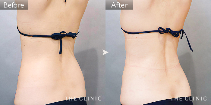 脂肪吸引「腰・ウエスト」の症例写真（35歳/女性）｜ザクリニック名古屋院
