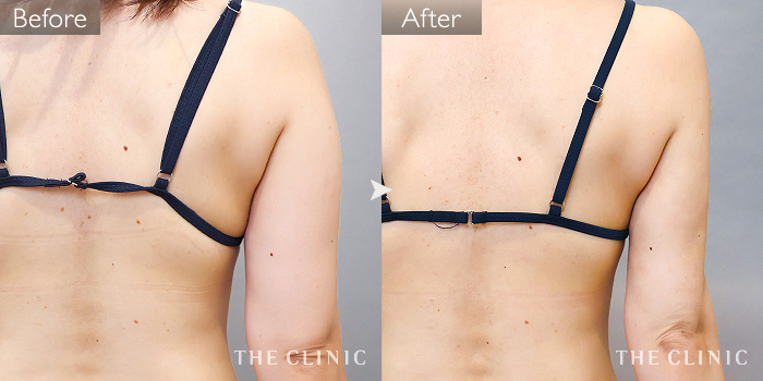 脂肪吸引「腰・ウエスト」の症例写真（35歳/女性）｜ザクリニック名古屋院