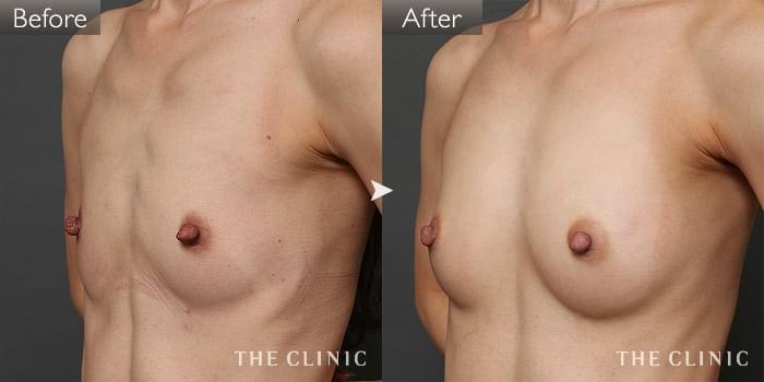 豊胸 コンデンスリッチ豊胸 の症例写真 28歳 女性 ザクリニック名古屋院