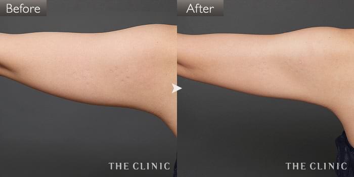 脂肪吸引 腹部 の症例写真 24歳 女性 ザクリニック名古屋院 脂肪吸引 腹部 の症例写真 24歳 女性 ザクリニック名古屋院