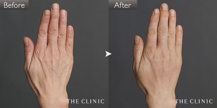 脂肪注入 手のシミ シワ改善 の症例写真 56歳 女性 ザクリニック名古屋院 脂肪注入 手のシミ シワ改善 の症例写真 56歳 女性 ザクリニック名古屋院