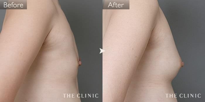 豊胸 コンデンスリッチ豊胸 の症例写真 36歳 女性 ザクリニック名古屋院