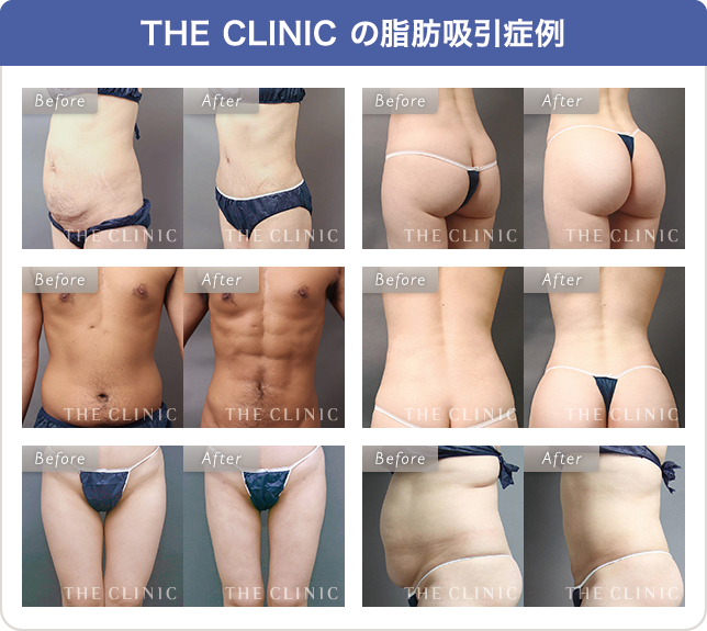 名古屋で脂肪吸引といえばザクリニック｜美容外科・形成外科