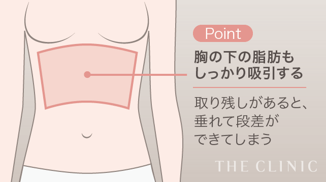脂肪吸引 腹部 の症例写真 24歳 女性 ザクリニック名古屋院 脂肪吸引 腹部 の症例写真 24歳 女性 ザクリニック名古屋院